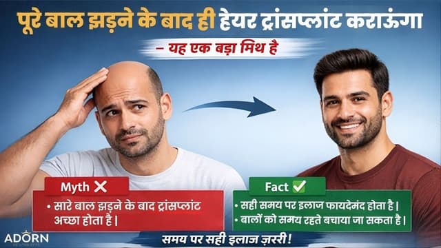 पूरे बाल झड़ जाने के बाद ही हेयर ट्रांसप्लांट कराऊंगा” – यह एक बड़ा मिथ है