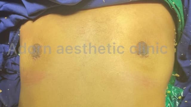 Gynecomastia: Restoring Confidence and Masculinity 
