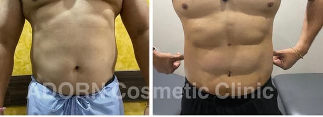 Six Pack Abs Liposuction: ctrl+alt+delete your Fat